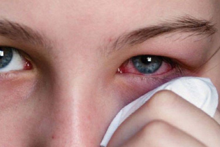 Göz yüzeyinde temizlenmeyen maddeler enfeksiyonu arttırıyor 